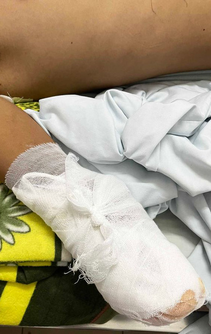 Gia tăng bỏng điện, nhiều trường hợp bị cắt cụt chi