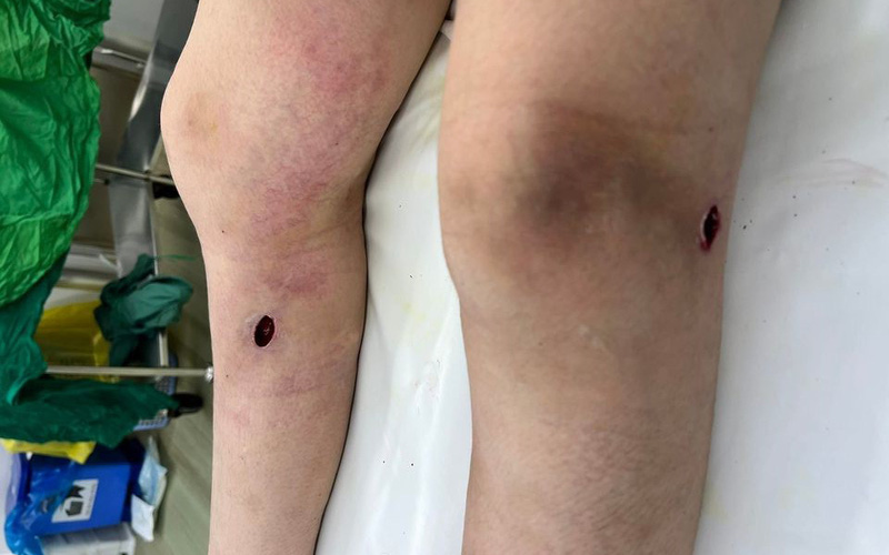 Áp xe gối, cẳng chân sau khi tiêm filler tại spa