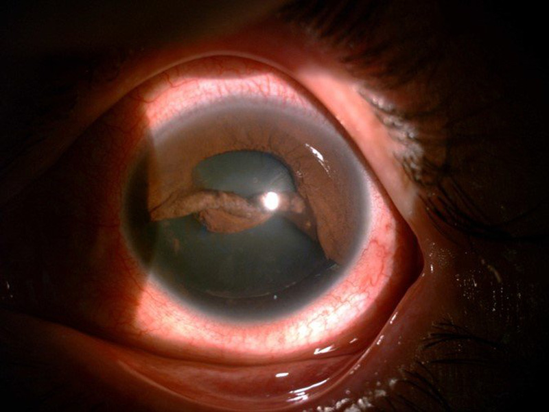 Bơm nước rửa xe, người đàn ông bị vòi xịt gây tổn thương mắt