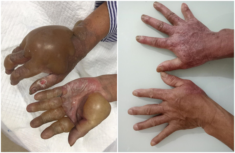 Cẩn trọng với tai nạn bỏng