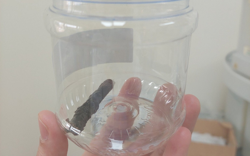 Cành cây dài 6,5 cm nằm trong phổi chàng trai người Mông suốt 14 năm