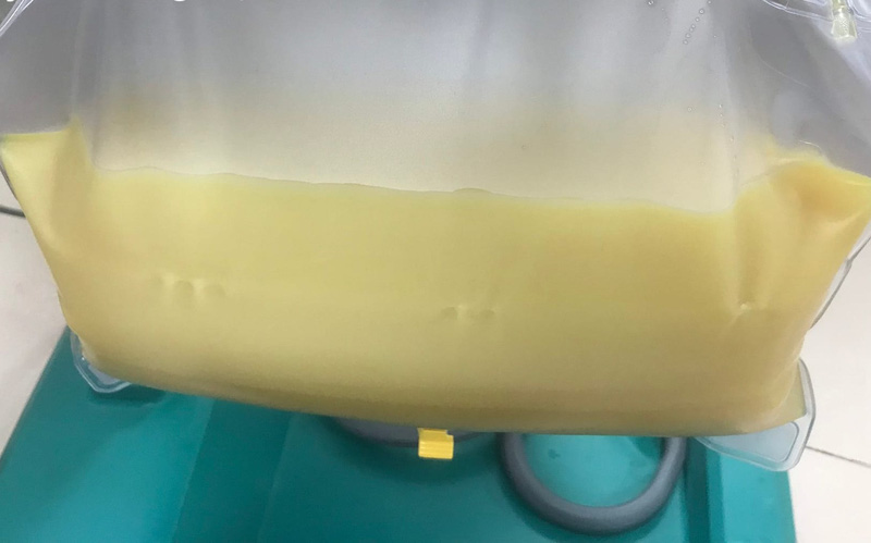 Cứu sống bệnh nhân có huyết tương trắng đục như sữa