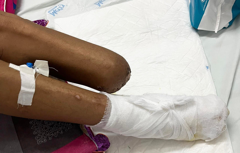 Gia tăng bỏng điện, nhiều trường hợp bị cắt cụt chi