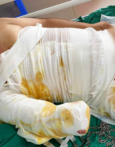 Gia tăng bỏng điện, nhiều trường hợp bị cắt cụt chi