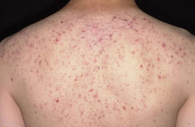 Suýt tử vong vì trị mụn ở lưng tại spa