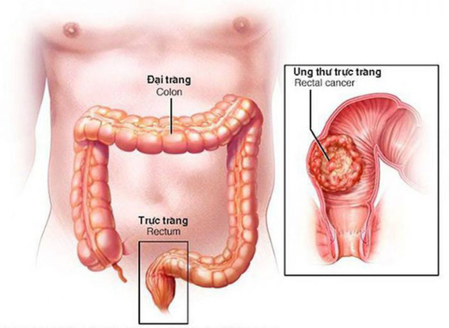 Thử nghiệm thiết bị phát hiện sớm ung thư trực tràng