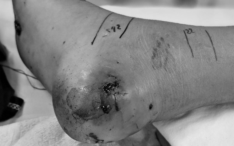 Tự ý đắp lá vào vết thương rắn cắn, bé trai bị nhiễm trùng nặng Tự ý đắp lá vào vết thương rắn cắn, bé trai bị nhiễm trùng nặng