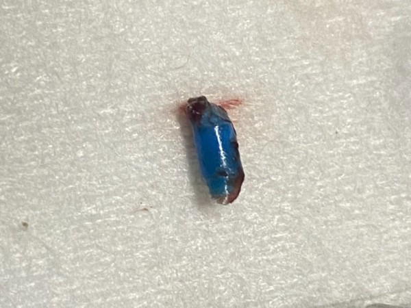 Cháu bé 4 tuổi bị bạn nhét đồ chơi vào tai