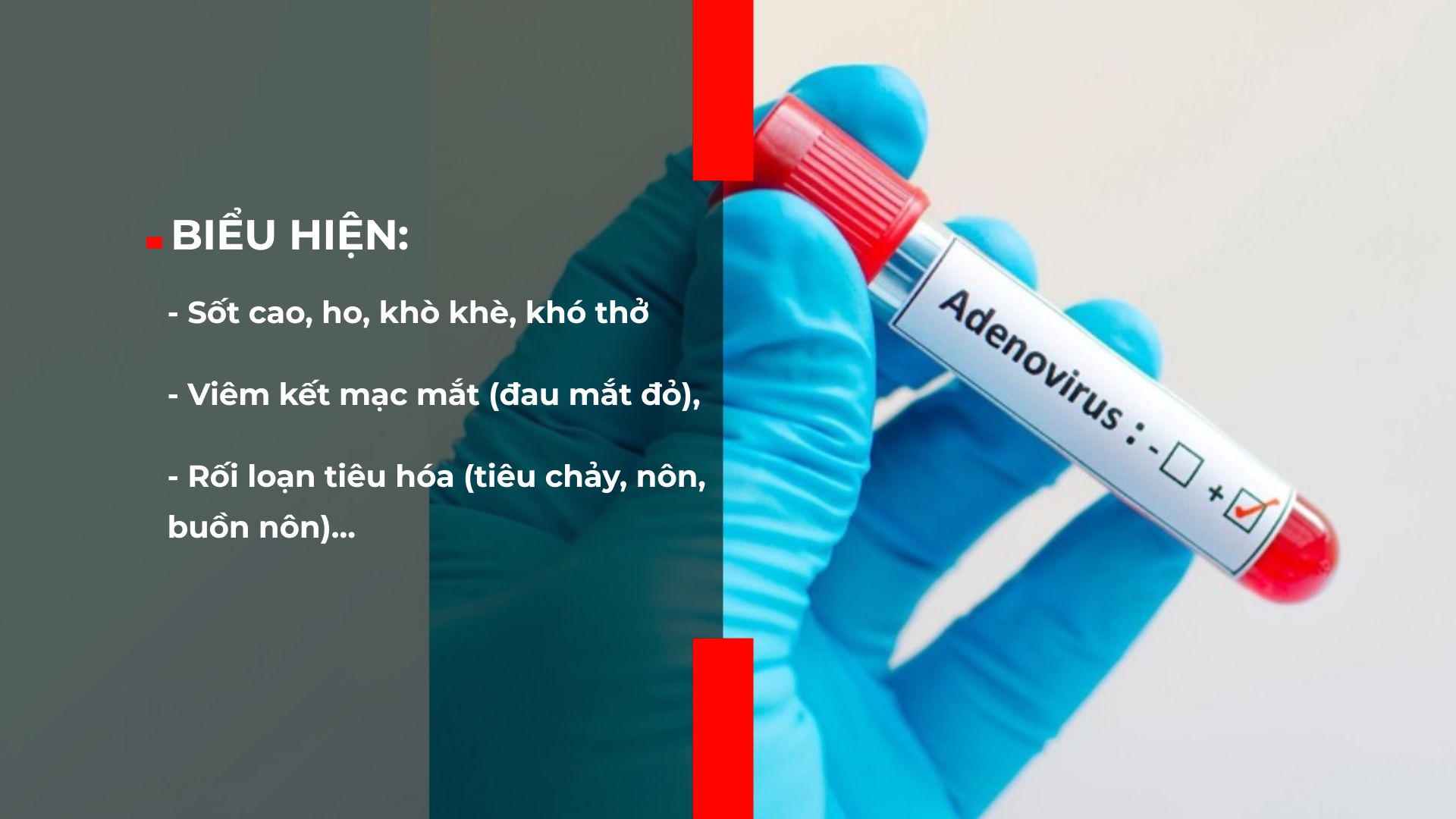 Dấu hiệu trẻ nhiễm virus Adeno?