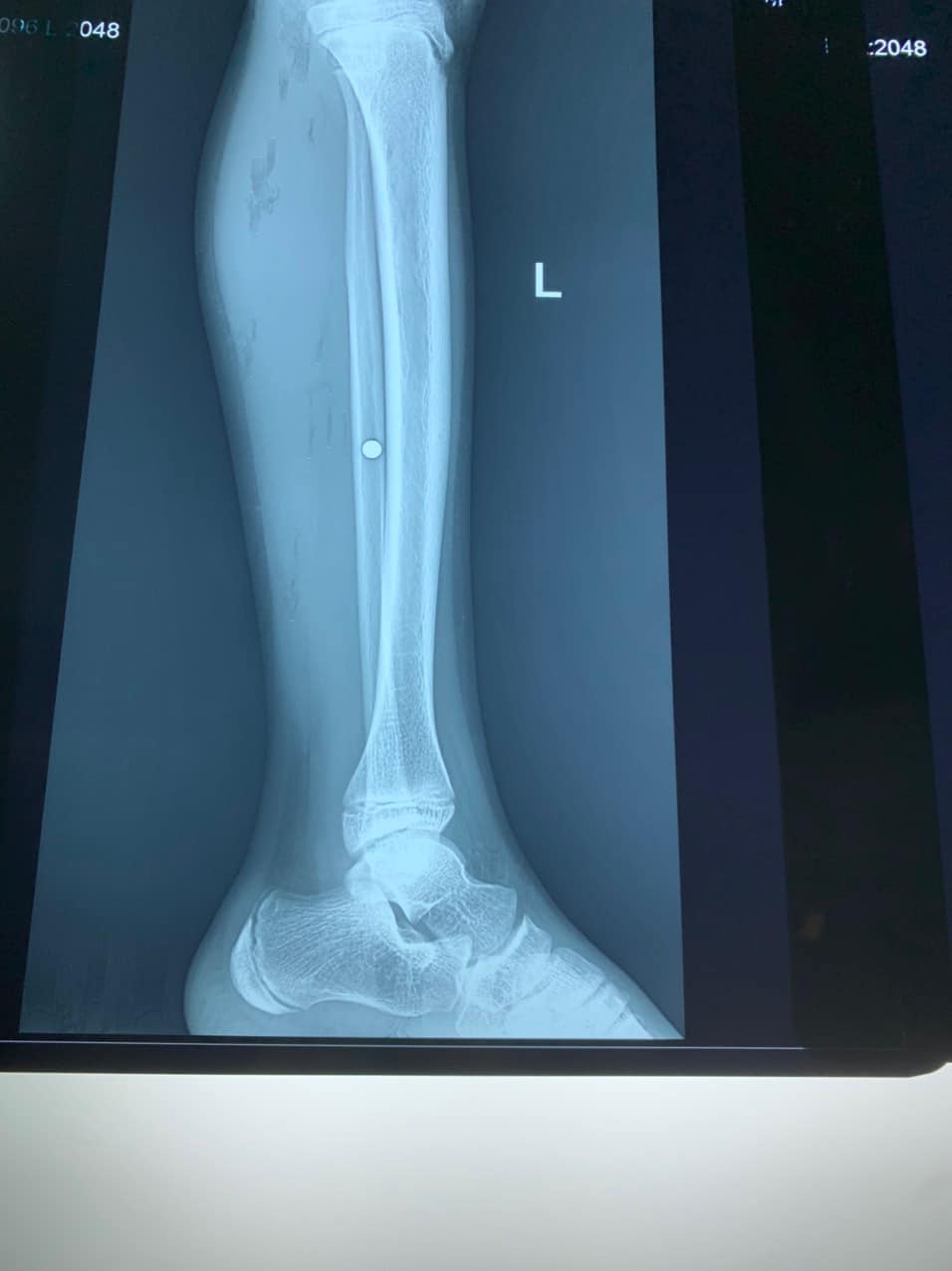 Cảnh báo chấn thương do súng tự chế Cảnh báo chấn thương do súng tự chế