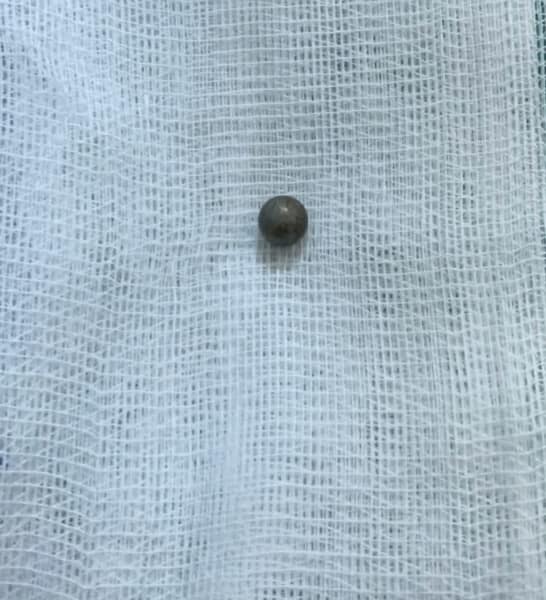 Cảnh báo chấn thương do súng tự chế Cảnh báo chấn thương do súng tự chế