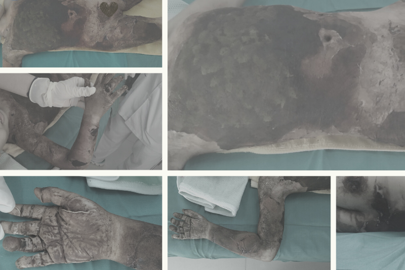 Đắp thuốc lá của thầy lang chữa bỏng, bé 5 tuổi bị biến chứng nặng nề