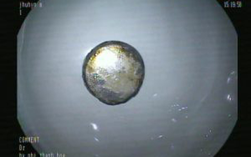 Gắp viên pin nằm trong thực quản bé trai 11 tháng tuổi