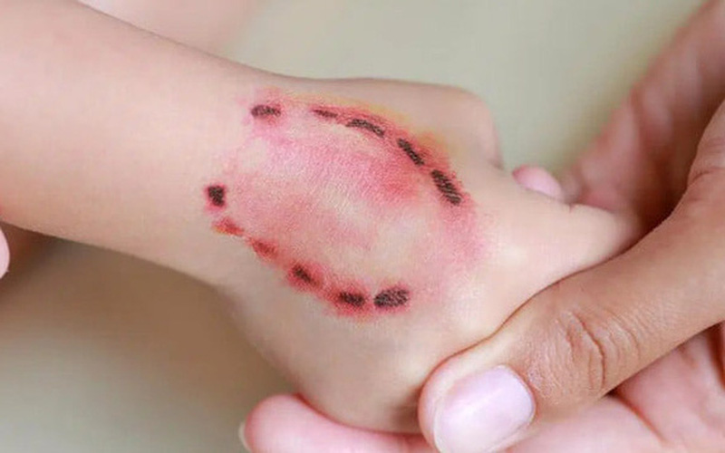 Ngày Thế giới Phòng chống bệnh Dại năm 2022: Một sức khỏe, không tử vong Ngày Thế giới Phòng chống bệnh Dại năm 2022: Một sức khỏe, không tử vong