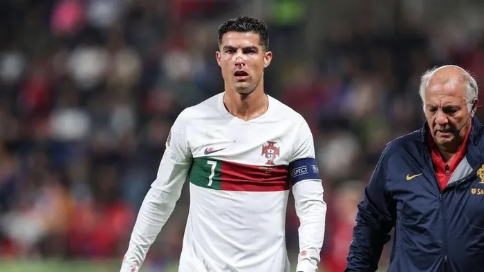 Ronaldo tập luyện với mắt thâm tím