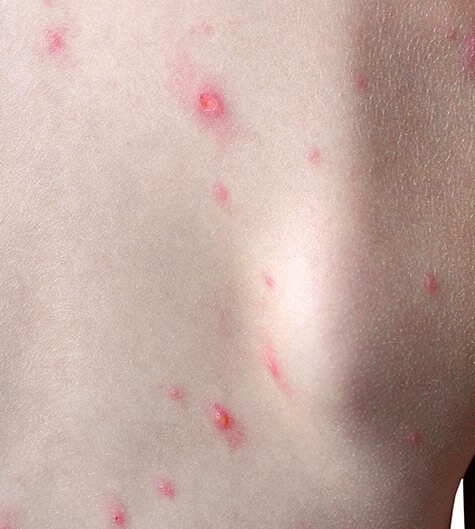 Bộ Y tế thông tin chính thức về bệnh nhân đầu tiên mắc bệnh đậu mùa khỉ tại Việt Nam