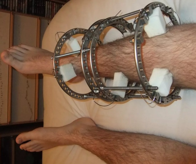 Các chuyên gia trong ngành công nghệ đang trả tới 120.000 USD để được kéo dài chân - Ảnh 3.