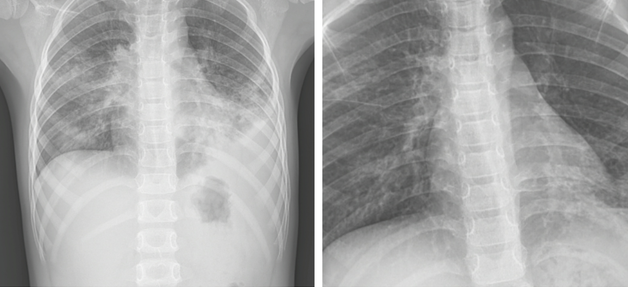 Viêm phổi do Mycoplasma - Bệnh nguy hiểm, cha mẹ không nên chủ quan