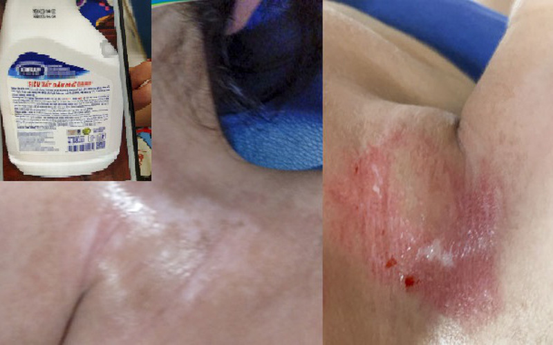 Cảnh báo bỏng hoá chất từ chất tẩy dầu mỡ