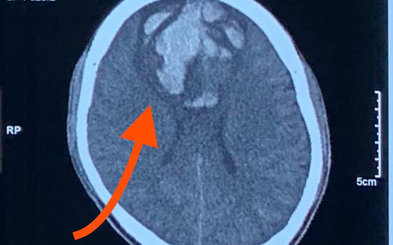 Cảnh báo chấn thương sọ não nặng do tai nạn lao động