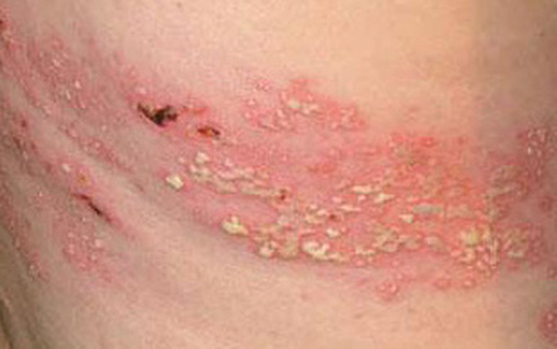 Cảnh báo tự mua thuốc điều trị bệnh Zona thần kinh tại nhà Cảnh báo tự mua thuốc điều trị bệnh Zona thần kinh tại nhà