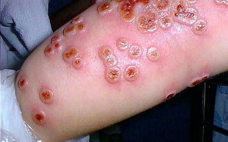 Góc giải đáp: Bệnh đậu mùa khỉ khác gì đậu mùa thường? Góc giải đáp: Bệnh đậu mùa khỉ khác gì đậu mùa thường?