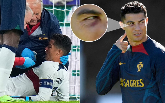 Ronaldo tập luyện với mắt thâm tím