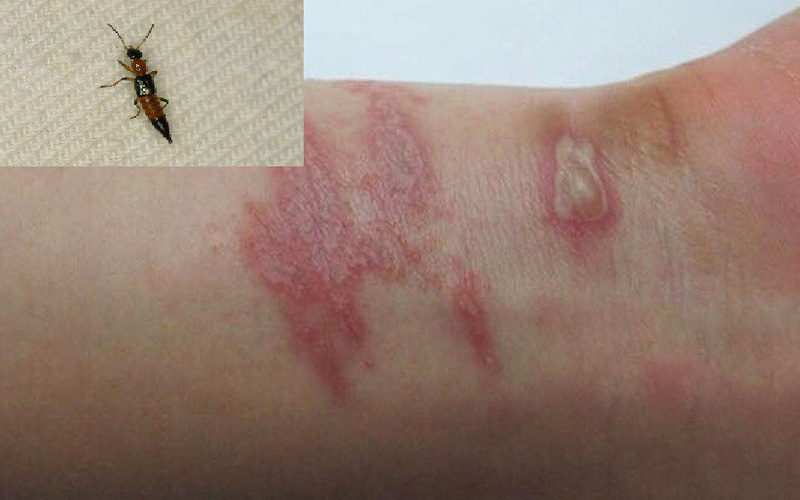 Sai lầm trong điều trị tổn thương do kiến ba khoang Sai lầm trong điều trị tổn thương do kiến ba khoang