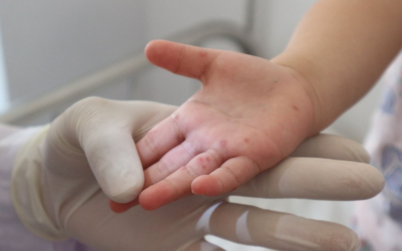 TP. Hồ Chí Minh: 95 ổ dịch sốt xuất huyết, 4 ổ dịch tay chân miệng phát sinh trong tuần qua TP. Hồ Chí Minh: 95 ổ dịch sốt xuất huyết, 4 ổ dịch tay chân miệng phát sinh trong tuần qua