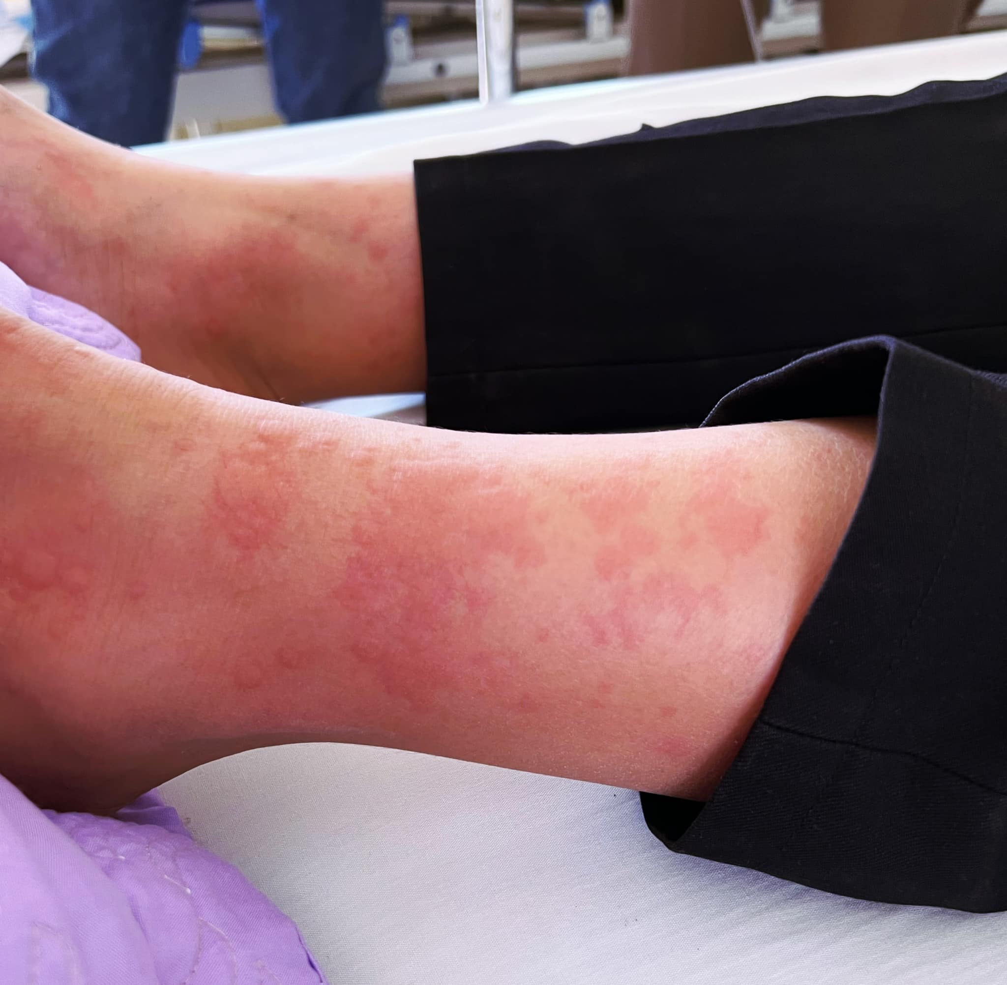 Bé 12 tuổi sốc phản vệ nguy kịch do ong mặt quỷ đốt