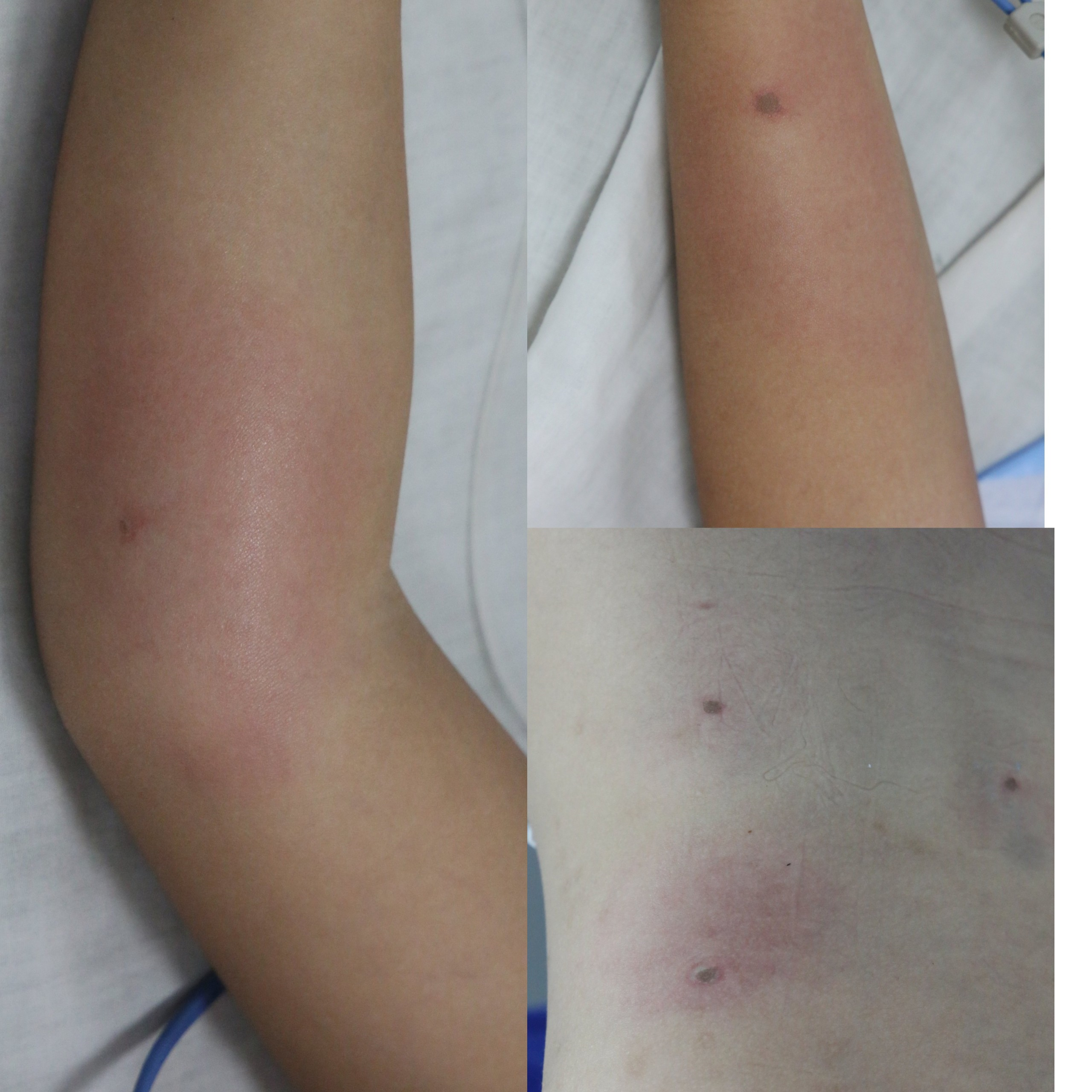 Tổ ong vò vẽ rơi trúng đầu, bé gái bị ong đốt nguy kịch