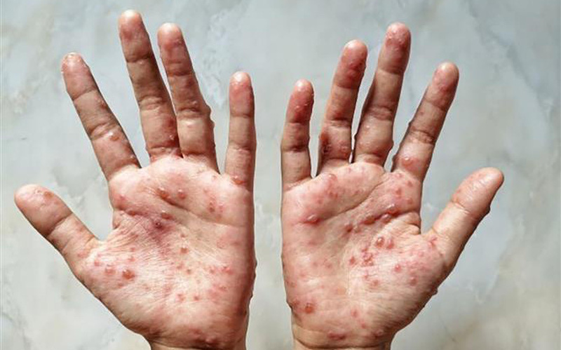 Bộ Y tế: Tăng cường phòng, chống bệnh đậu mùa khỉ tại Đắk Lắk