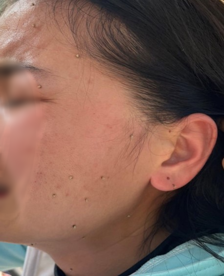 Cấp cứu nhiều bệnh nhân bị ong đốt