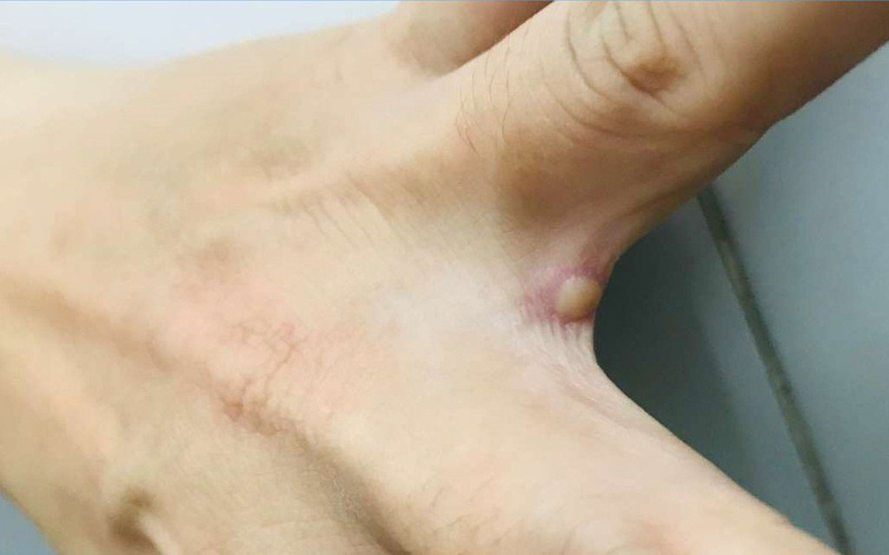 Đắk Lắk: Phát hiện một trường hợp trở về từ Nam Phi nghi mắc đậu mùa khỉ Đắk Lắk: Phát hiện một trường hợp trở về từ Nam Phi nghi mắc đậu mùa khỉ