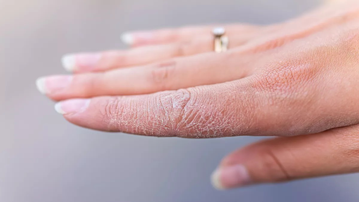 Làm thế nào để chăm sóc làn da khô hiệu quả?