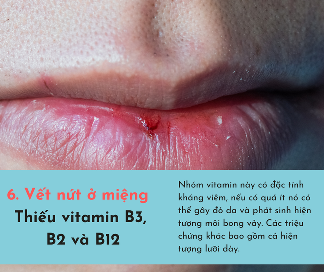 Cơ thể bị &quot;cạn kiệt&quot; vitamin sẽ phát ra 6 dấu hiệu, chủ quan bỏ qua có thể sẽ tổn thọ  - Ảnh 6.