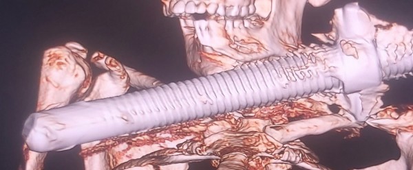 Nam công nhân ngã giàn giáo bị thanh sắt xuyên cổ nguy kịch
