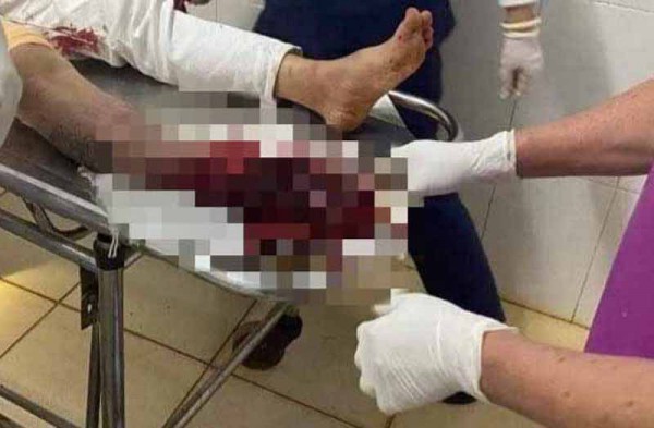 Đắk Lắk: Tìm người sau xô xát, lái ô tô tông nát bàn chân một thanh niên