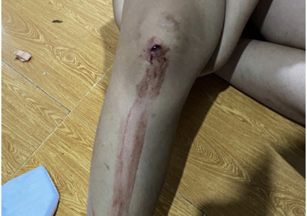 Đang ngồi trong nhà, hai chị em bị người lạ dùng súng bắn Đang ngồi trong nhà, hai chị em bị người lạ dùng súng bắn