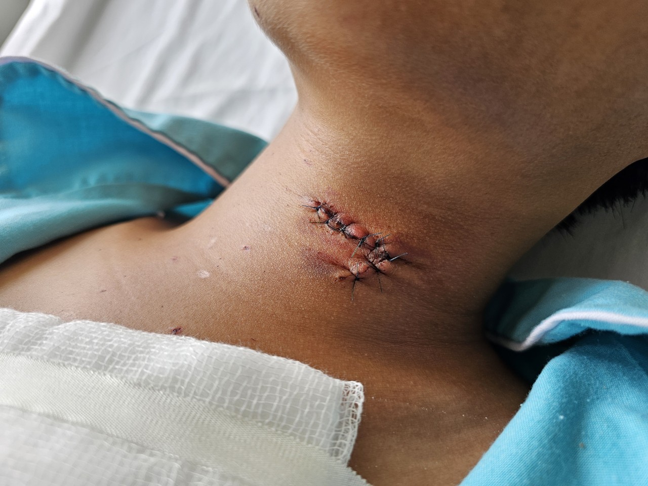 Lên mạng học chế tạo pháo nổ, nam sinh lớp 6 suýt tử vong- Ảnh 2.