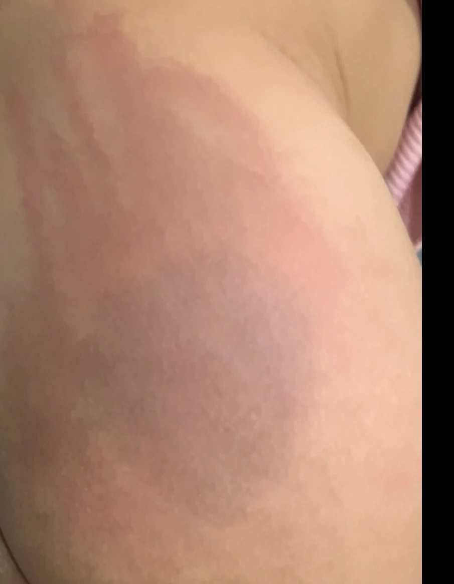 Trẻ mầm non có nhiều vết đỏ ở mông, quấy khóc, phụ huynh làm đơn - Ảnh 2. Trẻ mầm non có nhiều vết đỏ ở mông, quấy khóc, phụ huynh làm đơn - Ảnh 2.