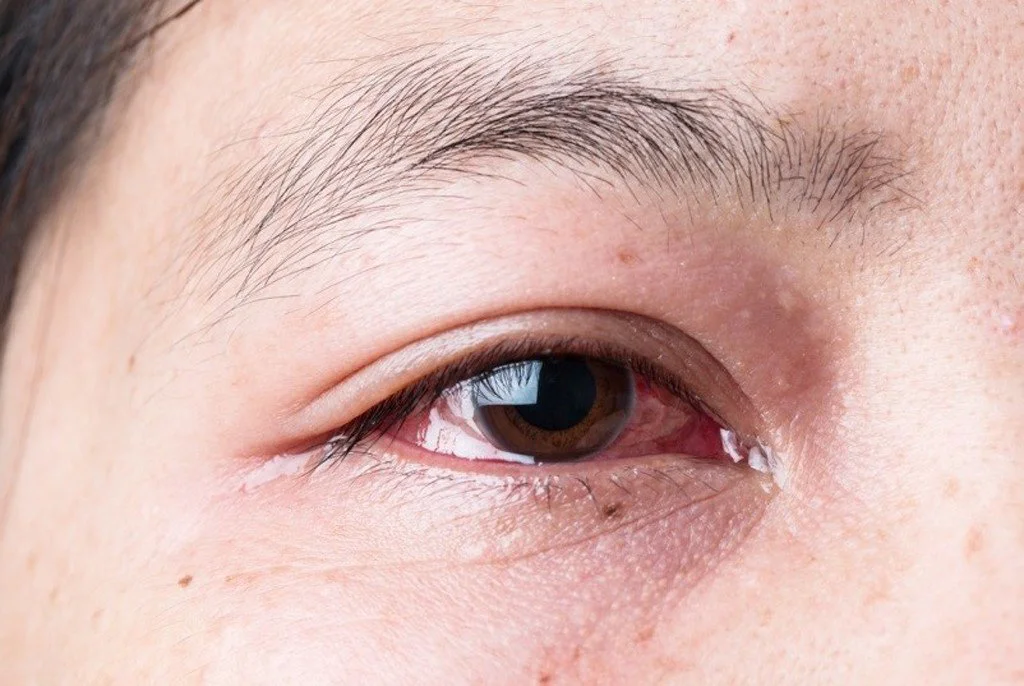 Bác sĩ chuyên khoa chia sẻ lý do bệnh đau mắt đỏ phức tạp hơn mọi năm và lưu ý quan trọng khi điều...