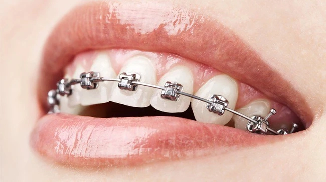 Niềng răng để "đều như hạt bắp, khuôn mặt cân đối": Có 5 kiểu cho bạn lựa chọn!