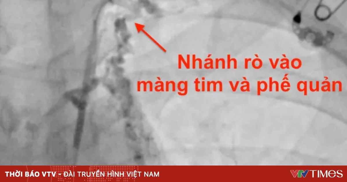 Đau ngực kèm theo khó thở, thanh niên phát hiện viêm phế quản “nhựa” hiếm gặp