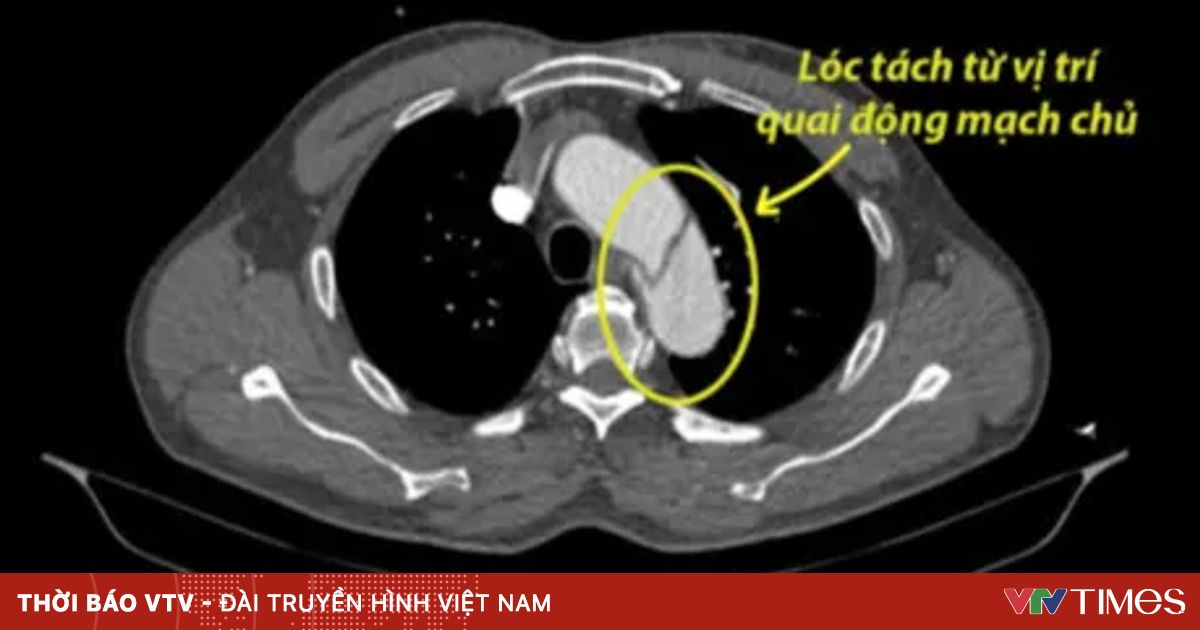 Kịp thời cứu người đàn ông bị lóc tách động mạch chủ ngực