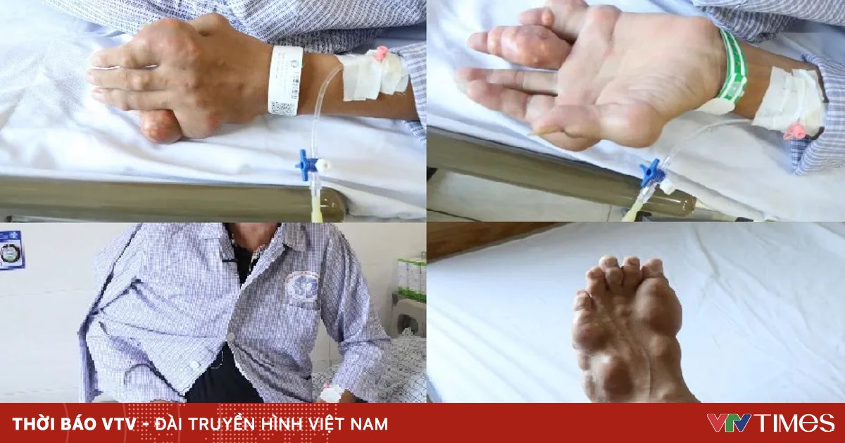 Rùng mình với tứ chi người đàn ông bị biến dạng khớp do bệnh gout