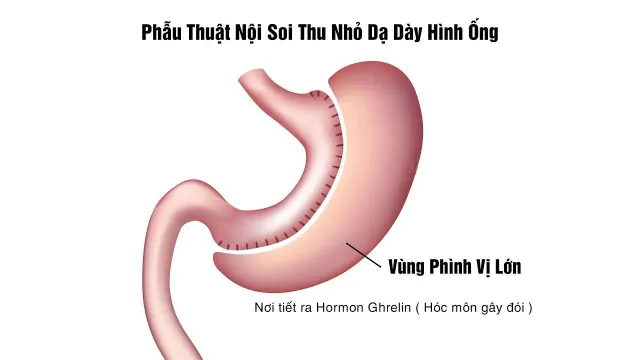 Điều trị béo phì bằng phẫu thuật nội soi thu nhỏ dạ dày hình ống - Ảnh 1.