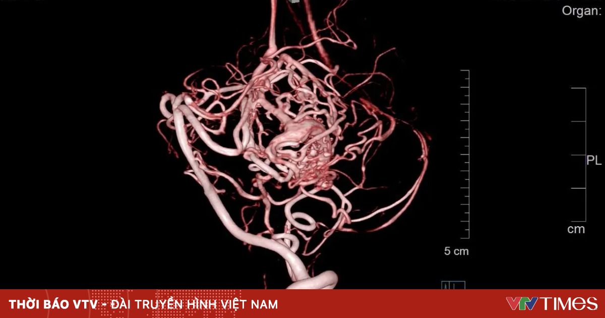 Bé trai 12 tuổi bị đột quỵ sau khi chạy bộ thể dục tại trường