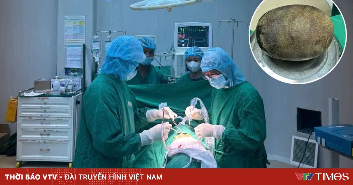 Hy hữu: Lấy viên sỏi nặng 700g trong bàng quang người đàn ông