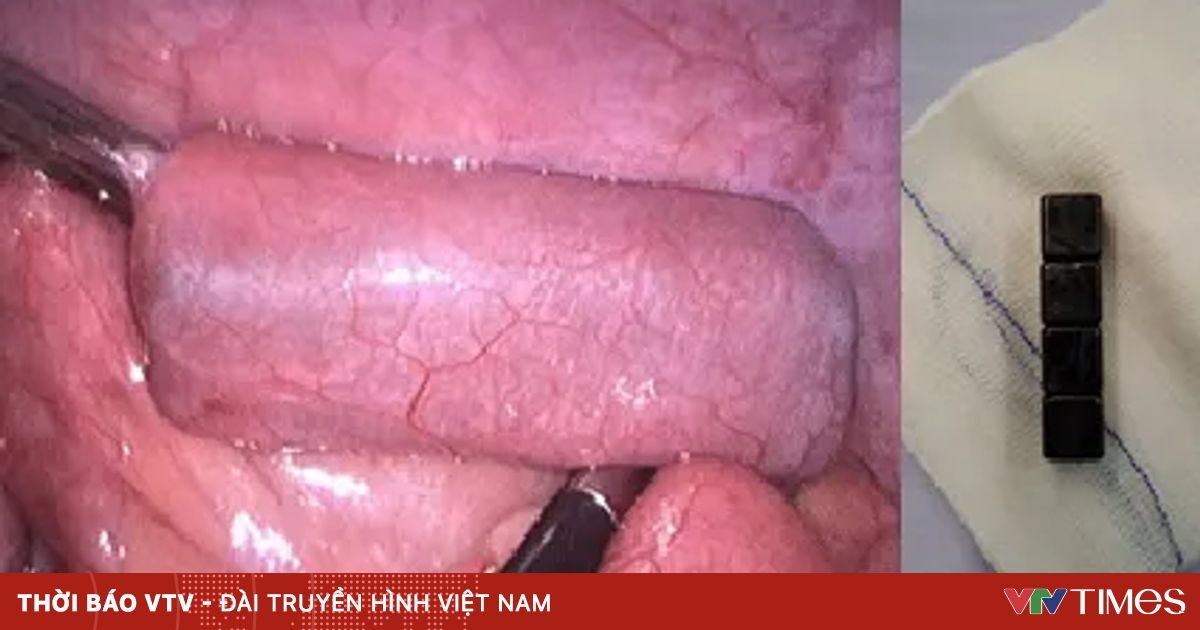 Kịp thời lấy 4 viên nam châm trong ruột bé trai